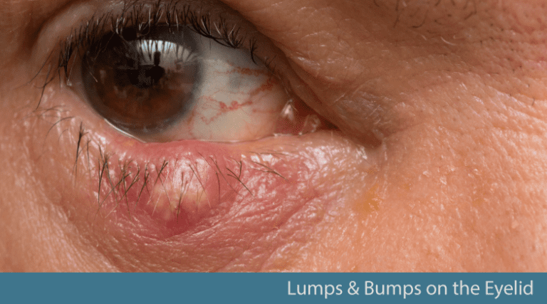 Lumps And Bumps On The Eyelid Causes And Solutions Illinois Eye Center